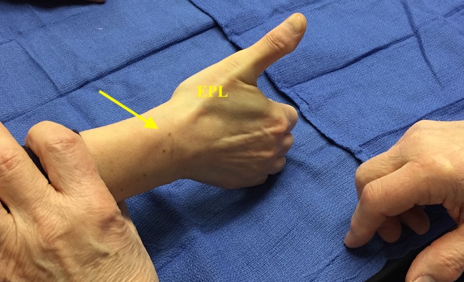 Lister's Tenderness (Drummer Boy's Palsy Extensor Pollicis Longus